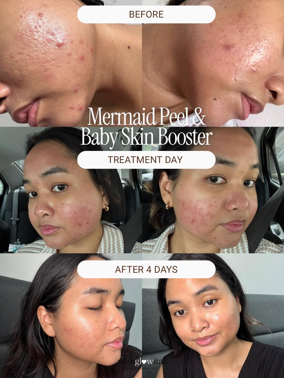 Cystic Acne Barrier Repair