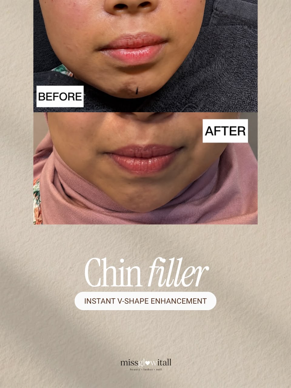 Chin Projection & V-Profile