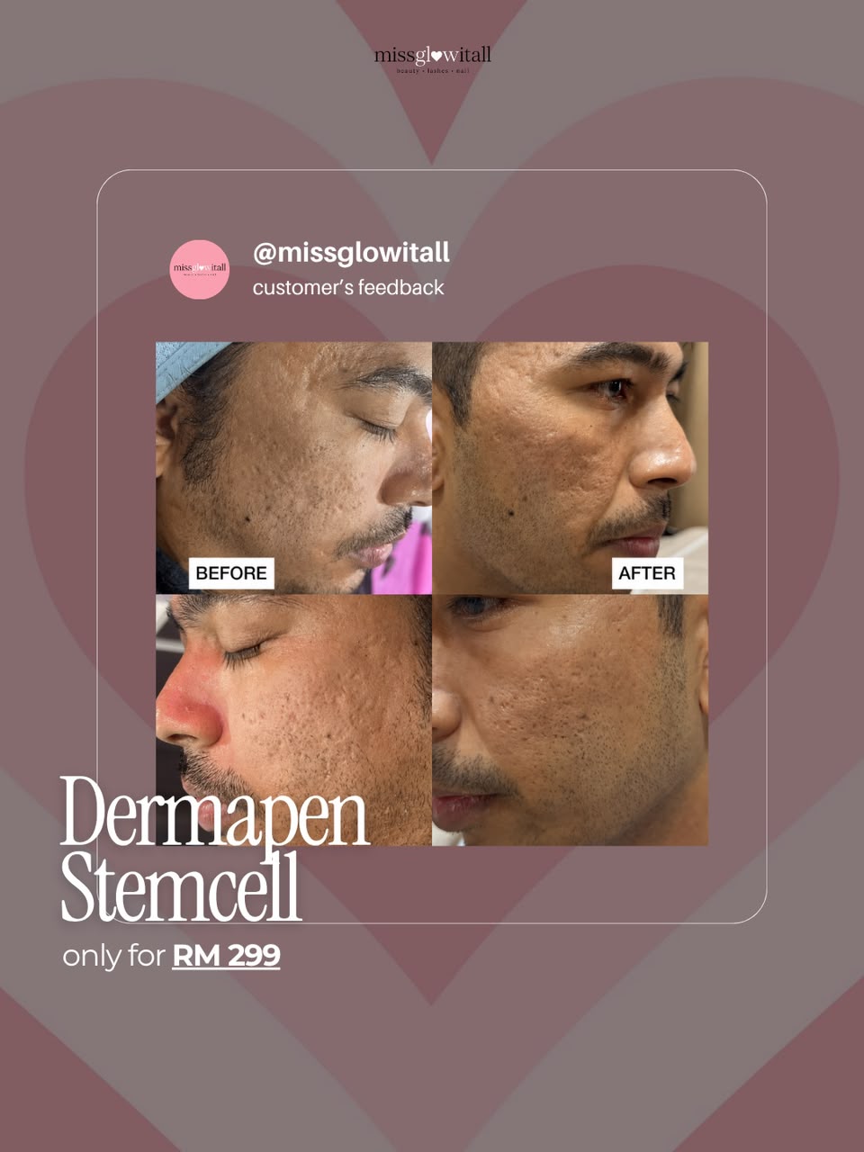 Rolling & Boxcar Pitted Acne Scars