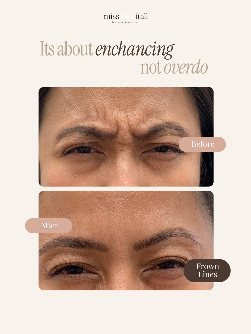 Forehead Wrinkles & Glabella Frown Lines