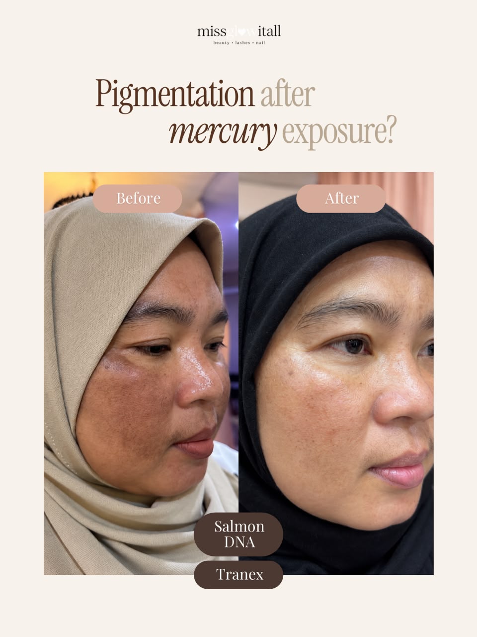 Rebound Melasma After Toxic Mercury Exposure