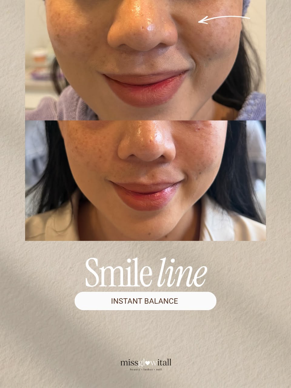 Nasolabial Crease Softening