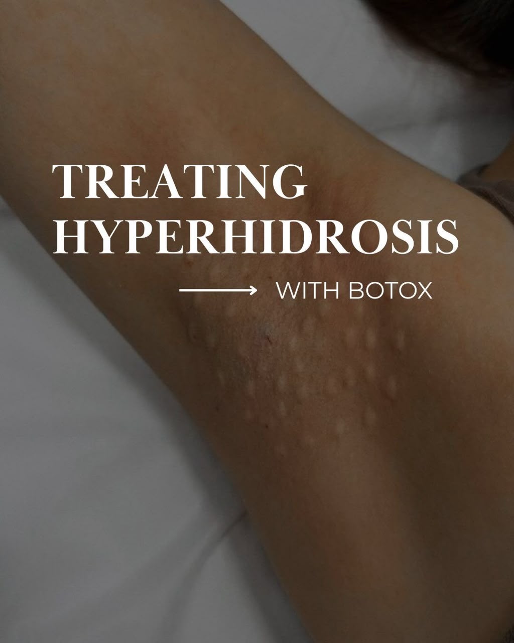 Hyperhidrosis Underarm Botox